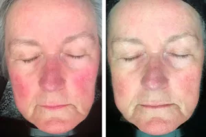 What is Rosacea and how can it be treated and managed?