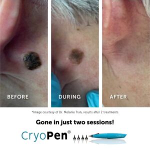 Age Spots before and after