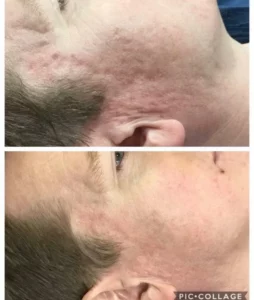 Acne Scars and treatment before and after in Buckinghamshire