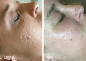 Teenage and young adult acne Scars before and after a course of treatments