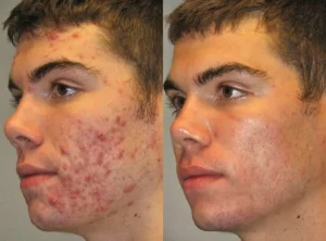 Teenage hormonal acne before and after DMK treatment