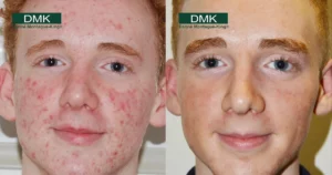 Acne-treatment-teenagers