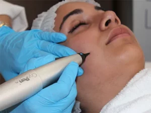 Skin tags being removed safely with CryoPen cryotherapy