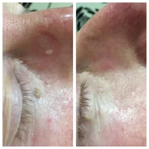 Skin Tag removal on face, hands, back, chest, groin, under arms, scalp