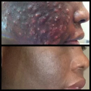 Acne treatment before and after treatment at Skin Revision