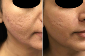 Acne scar reduction following treatment 