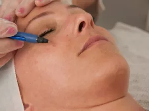 Mole removal with VeinAway