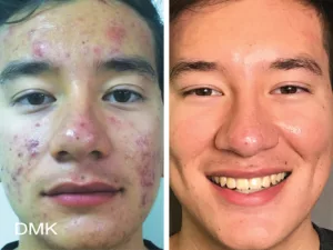 Acne treatment before and after treatment at Skin Revision