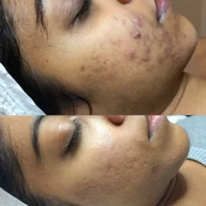 before and after following acne treatment with DMK