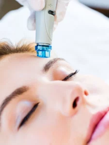 Hydra Facial for blackhead removal