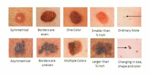 Mole images under dermascope