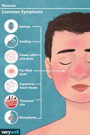 what are the causes of Rosacea and how can rosacea be managed