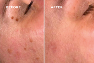 Skin Tag removal before and after treatment at Skin Revision Beaconsfield