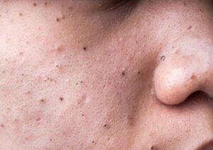 Blackheads and how they can be treated effectively