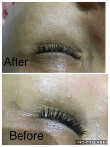 Milia - before and after treatment at Skin Revision