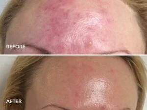 Dermalux-LED light therapy before and Psoriasis