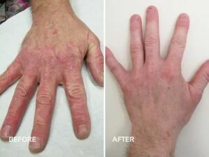 Dermalux-Tri-Wave-LED and Psoriasis-on-hands - courtesy of Fiji clinic with permission