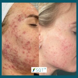 SQT  treatment for teenage acne after just one treatment