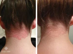 Psoriasis-before-and-after-