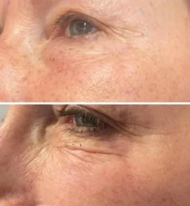 Jet Plasma and Plaxel non surgical eyebag removal treatment