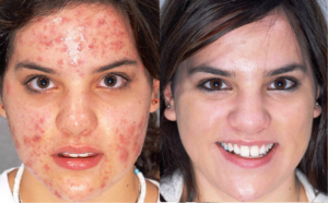 Teenage Hormonal Acne on young girl following DMK treatment