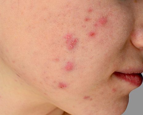Acne, teenage acne, hormonal acne, cystic acne