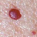 Cherry Angioma / Blood Spot / Campbell de Morgan