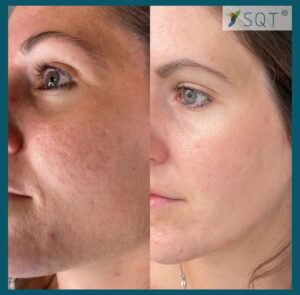 SQT Microneedling for acne and acne scars