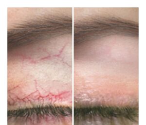 Thread Veins above the eye are treated and removed with VeinAway