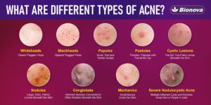 Types of acne