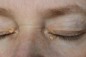 Xanthelasma causes, treatment and prevention