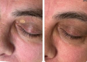 Xanthelasma before and after treatment with CryoPen