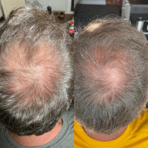 Hair Growth treatment for hair loss