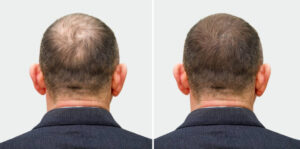 Hair loss treatment on man before and after 