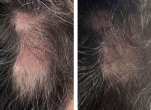 Hair loss treatment before and after 8 treatments with Jet Plasma