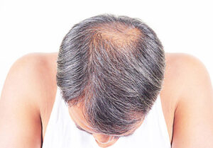 Male man with thinning hair looking for hair loss treatment