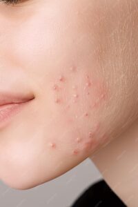 what are the effective treatments for teenage acne