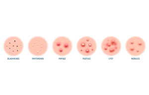 Types of acne caused by blackheads